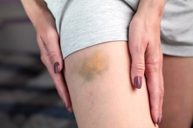 Često imate modrice? Ovo su mogući razlozi zašto se pojavljuju